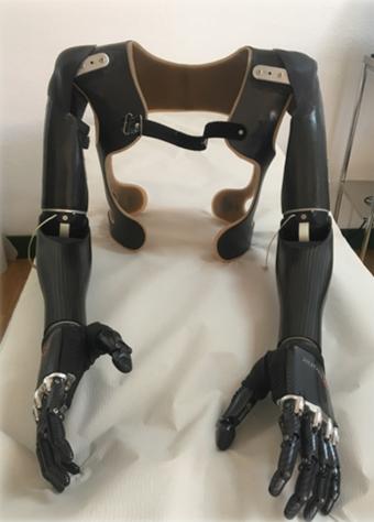 Imagen de la prótesis de brazos implantada al paciente 