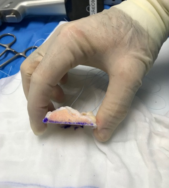 El paciente es un varón de 49 años, que sufrió hace años una fractura de meseta tibial interna y que en la actualidad presentaba dolor habitual, así como una deformidad de la rodilla