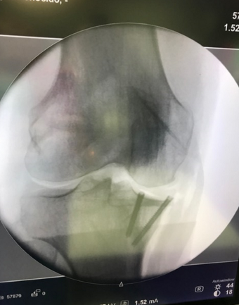 La ventaja de esta indicación es preservar la articulación del paciente, evitando la implantación de una prótesis de rodilla a corto plazo 