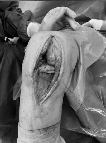 Para la recuperación el paciente no debe apoyar durante las ocho a diez semanas posteriores a la cirugía