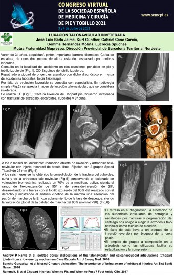 Poster Luxación Talonavicular Inveterada