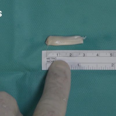 Porción del tendón