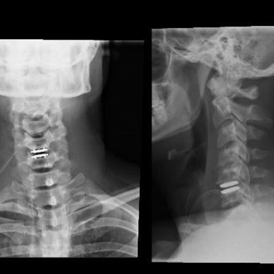 Artroplastia de disco c5-c6