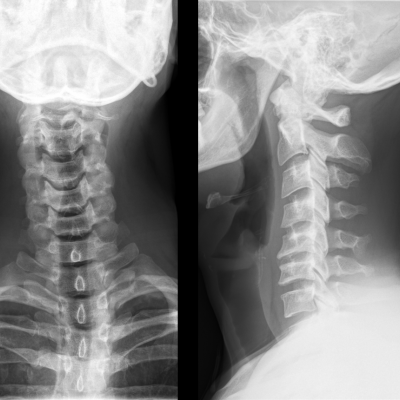 Discopatía cervical c5-c6
