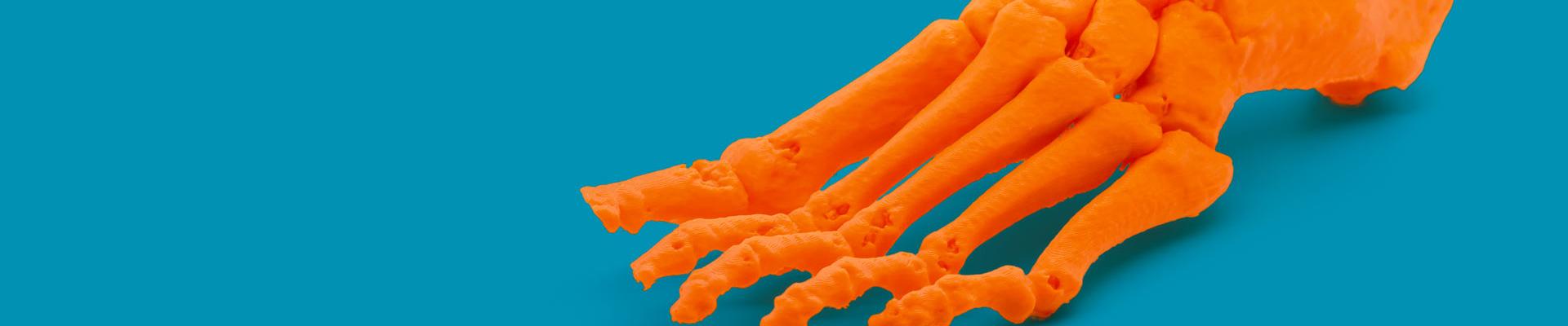 Las figuras en 3D permiten que el cirujano opere al paciente teniendo datos más reales de la lesión ósea