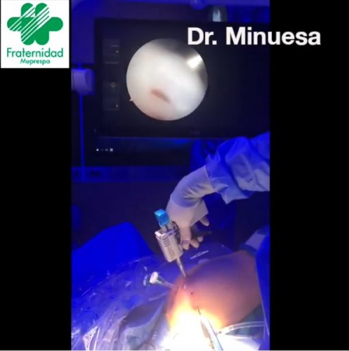 Colocación de un parche Regeneten en un hombro dañado